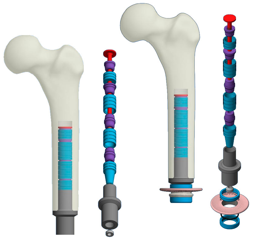 Exo prosthesization