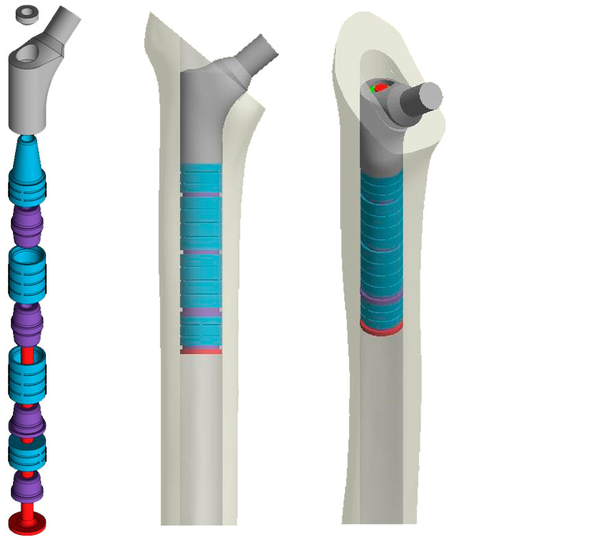 Articular athroplasty